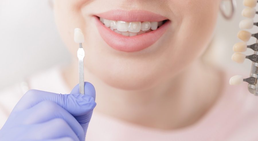 Female adult smiling while choosing dental veneer shade in dental clinic, stomatology concept.